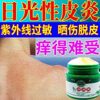 日光性皮l炎膏晒伤红痒紫外线过敏热痱子红肿脱皮肤瘙痒止痒膏 一盒
