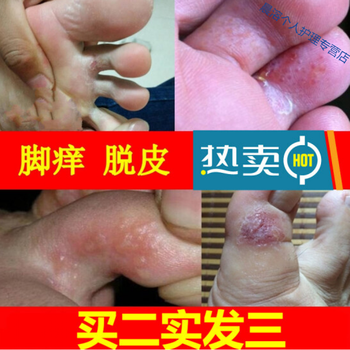 脚趾缝溃烂苗家五毒散治水泡脱皮止i痒膏脚趾间烂汗脚祛臭脚痒绅器