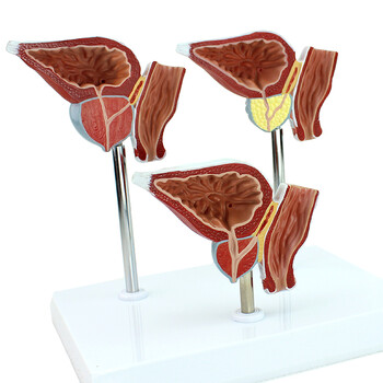 enovo颐诺前列腺病变模型医学模型男科医患沟通增生癌bph检查男科生殖