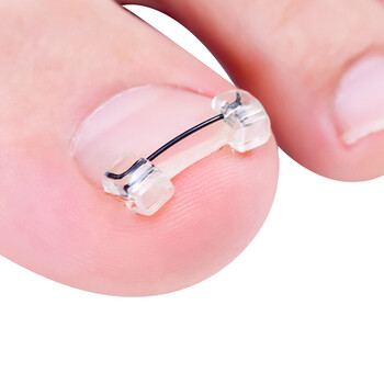 梦多福 嵌甲矫正器 无需胶水正甲贴卷甲沟炎脚趾甲长肉里卷甲修正美甲