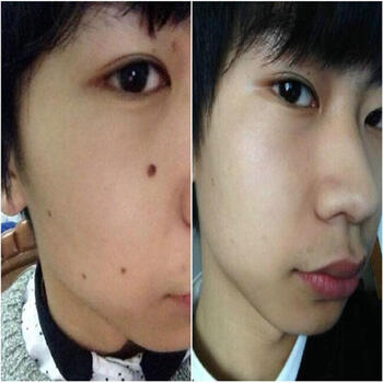 【15天去痣点痣膏祛痣灵金水神器药水产品去胎记痦子苍蝇屎黑点 一套