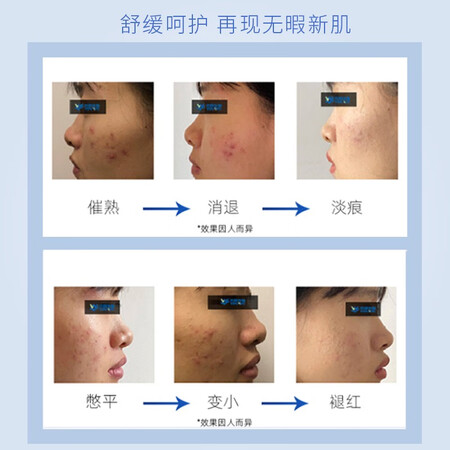 sakosesakose凡士林焕颜净痘贴1盒装口碑如何_http://www.meifudie.com_好物_第5张