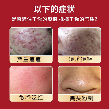 过来人吐槽芭莎叶壬二酸凝胶15%软膏祛痘精华凝露水杨酸唑去淡化黑头粉刺痘印乳膏 壬真实感受咋样？用后1个月爆料评价！