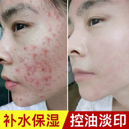 使用对比妍瑟芦荟胶300ml 膏淡化痘坑补水舒晒后护理保湿面霜男女是否值得买？评测揭秘价格值不值！