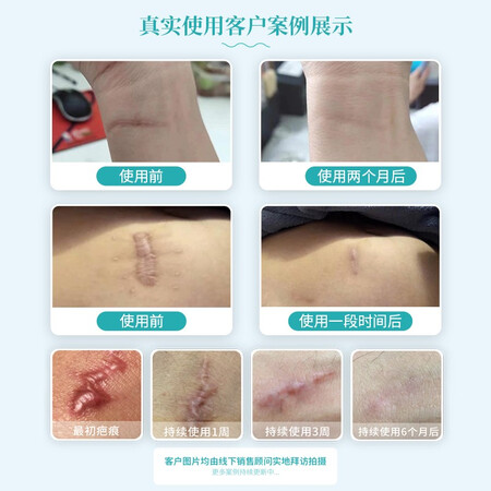 请问感受蜕芭疤痕贴 归领医疗 祛疤医用去疤痕贴刨剖腹产手术自粘贴疤是否划算？小白千万参考评测！