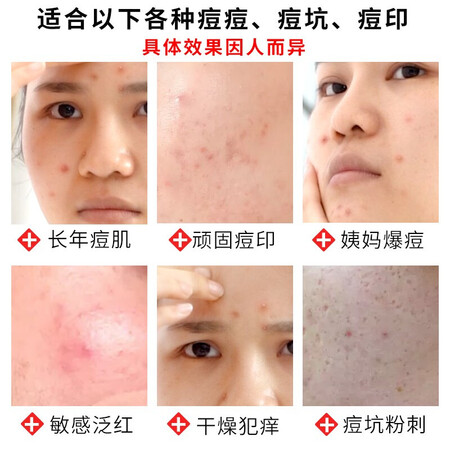 入手剖析点评仁和芦荟丹参祛痘膏草本精华修复护理凝胶烟酰胺淡化痘疤痘坑真实反馈如何？使用一年客观点评！