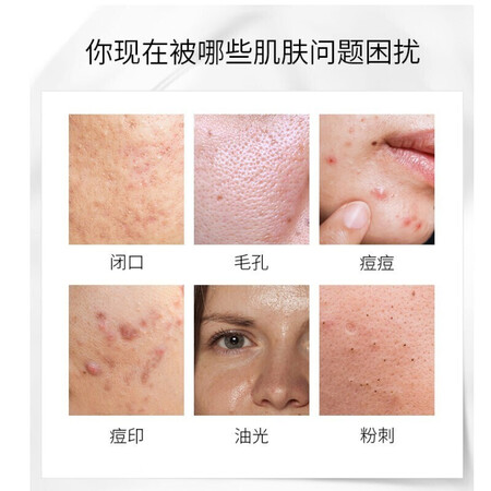 良心解密同仁堂控油祛痘膏草本淡痘印淡化痘坑痘疤保湿祛痘凝胶霜青春是否值得呢？真相揭秘啦！