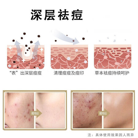 网友说说同仁堂控油祛痘膏草本淡痘印淡化痘坑痘疤保湿祛痘凝胶霜青春真相评测如何？入手三星期感受告知！