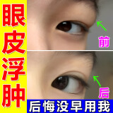 肿眼泡去脂消肿消除眼睛眼部脂肪厚上眼皮浮肿水肿红肿熬夜眼肿上眼皮松弛提拉紧致眼部消脂贴大人小孩可用 组合强效装【去肿效果一绝】