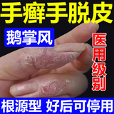 手癣特用傚药手足癣真菌感染药膏脱皮开裂鹅掌风汗疱疹抑菌膏手上起小水泡手干脱皮瘙痒专用药硝酸咪康唑乳膏 3盒装【瘙痒起泡脱皮干裂】