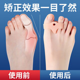 日本硅胶大脚趾拇指外翻矫正器姆外翻大脚骨纠正男女可穿鞋日夜用 肤色1双（均码）
