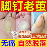 脚钉软化膏去除厚脚垫老茧去脚底板硬皮死皮脚掌趾指头软化剂非药 单盒装