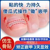 惜药师甲沟炎矫正器贴片正甲贴隔离填充垫片嵌甲脚指甲矫正钢丝改正神器 10只丝（送5镍合金片）
