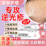 逆光疹去闭i口粉刺克星小孩脸上长硬疙瘩丘疹额头上长小粒痘痘有炎症的样子修复皮肤屏障祛痘除螨去除药膏医 逆光疹闭口粉刺专用膏