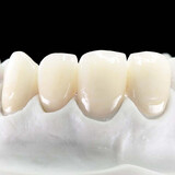 DALEK 戴立克二氧化锆全瓷牙烤瓷牙套牙冠牙齿假牙美白牙齿 3M蛀牙补牙超声波洗牙洁牙全瓷超薄贴面 威兰德全瓷牙