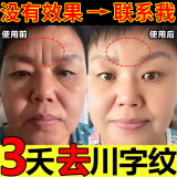 丝幕川字纹去除神器去法令纹去抬头纹男士去皱纹抗衰老紧致嘴角八字纹 男女通用【1盒】