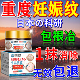 秋雅奈绪妊娠纹修复霜产后去疤痕消除紧致肚皮松弛专用淡化祛生长肥胖纹膏 一盒【体验装】 妊辰纹膏 妊娠纹油孕妇专用进口