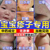 婴儿宝宝湿疹药膏湿毒清湿疹止痒去门根湿毒皮肤瘙痒皮炎湿疹真菌感染止痒药膏专用肛周潮湿顽固屁股痒长痘痘久坐湿疹坐疮起疙瘩 【买2送1】瘙痒红斑 宝宝难受 儿童湿疹100%特效