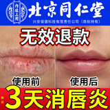 北京同仁堂医用唇炎大药房专用润唇膏慢性唇炎嘴唇干裂脱皮修复口角嘴唇上火起泡儿童成人孕妇 医用级【1支装】日常护唇润唇