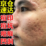 内廷上用祛痘印去痘坑去痘疤痘印痘坑修护复凹洞黑色素沉淀淡化 一盒体验装【拍二發三】