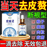 疣瘊克皮赘肉粒去除神器脖子上长的小疙瘩肉瘤祛疣体瘊猴子专用膏药进口 100%特效1盒   扁平疣丝状疣点痣