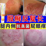 [舒夫林]曲安奈德益康唑乳膏 25g 3盒装 大腿根内测潮湿瘙痒股癣真菌感染腹股沟股癣私处股藓专用药膏皮肤用药非处方 大腿内侧潮湿瘙痒
