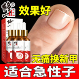 修正亮甲灰指甲可搭中药治根专用指甲真菌感染脱甲坏甲新甲抑菌液90ml