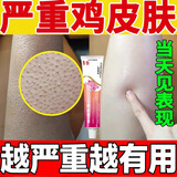 维A酸乳膏去鸡皮肤疙瘩毛囊角化症专用药去药除大腿胳膊手臂鸡皮肤角质增生引起丘疹红点粉刺鸡皮疙瘩 3盒周期装【多数人选择 大面积鸡皮肤】