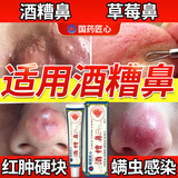 示博士酒糟鼻草莓鼻红肿玫瑰痤疮红鼻子专用去粉刺黑头红血丝螨虫修护软 一盒初期装（轻微型） 搭红鼻子酒糟鼻头红肿消炎产品用