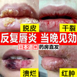 唇炎专用医用级唇炎膏唇炎唇膏儿童唇炎药膏慢性嘴唇干裂口角炎 特效专用【单盒】唇炎