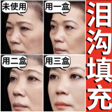 眼窝泪沟填充神器脸部凹陷填充液面部丰盈修复凹坑太阳穴胶原蛋白 脸部填充【支持试用】 30ml 5瓶装