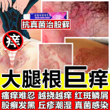 股癣i药膏大腿内侧阴囊私处瘙痒股藓真菌感染皮肤用药非处方潮湿湿痒疹止痒去看根硝酸咪康唑乳膏男人专用 3盒【可杀灭真菌股癣大腿内侧】