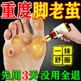 百易方去脚底老茧去硬皮软化膏茧子去除脚钉去脚根底厚后跟去茧王软化膏 一盒装*【发货特效快】 脚部 软化角质 去死皮
