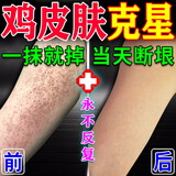 鸡皮肤疙瘩毛囊角化去除手臂胳膊上腿上的小疙瘩大腿毛周角化症膏 30g 1盒 【单盒装】