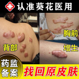 葵花疤痕灵增生凸起痒去除疙瘩修复止痒除疤膏医用手术烧伤烫伤疤凝胶 买3送2共发5盒【推荐装】 去疤痕修复凝胶医院专用祛疤膏去疤痕修复去除瘢痕疙瘩
