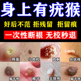 救扶仙仙扶堂刺猴专业用的药刺猴子寻常疣去除药膏肉粒刺猴疙瘩去·疣瘊 买3送2[顽固刺猴专用]医师推荐