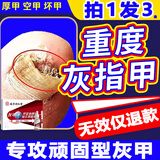 南京同仁堂灰指甲100%特殊效专用灰甲净灰甲套装液体35g*3