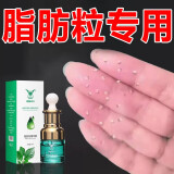 脂肪粒去除膏非药神器眼部专用去脂肪粒克油膏脂粒眼霜眼周白色除 一盒装【巩固装】