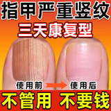 久木堂指甲竖纹修复生长液美甲受损开裂甲肉分离空甲凹凸不平护甲营养液 单盒装【指甲受损】