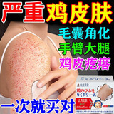 岩井昃弘进口鸡皮肤疙瘩毛周角化症专用干燥毛囊角质疙瘩大腿神器100%药膏 特效1盒装【去除鸡皮肤】 鸡皮肤去除神器100%