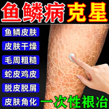 洛神医鱼鳞病专用的药鱼鳞皮肤霜去鱼鳞蛇皮病干燥脱皮鸡皮肤进口身体乳 特效：一盒装【轻度鱼鳞皮】
