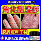 【德国品牌】角化型湿疹专用膏手足癣真菌感染脱皮瘙痒可搭药BD 送棉签【单盒装】手部角化型湿疹     特快效发货