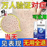 乔记鸡皮肤去除神器去鸡皮肤毛囊角质疙瘩大腿毛囊角化症专用非药乳膏 1盒装【无买赠无试用】 全身鱼鳞毛囊炎堵塞毛周角化干燥