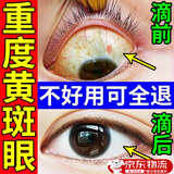 卓医师黄斑病变眼药水成人眼白去黄白眼球发黄去眼底血丝非叶黄素滴眼液 黄斑病变眼药水一瓶