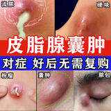 皮脂腺囊肿专用药膏去除皮下痘痘粉瘤增生脂肪硬块脓包结节暗疮火疖子专用软膏皮肤用药 莫匹罗星软膏 3盒【脂肪硬块脓包流脓】对症真管用