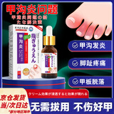 岩井昃弘甲沟炎专用嵌甲药祛息除肉软化剂药水指甲往肉里长缓解消肿去肉芽 【30ml/瓶】