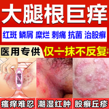 股藓股癣专用药膏大腿根内侧潮湿瘙痒股癣发黑男士私处止痒体癣花斑癣铜钱癣真菌感染克霉唑乳膏素喷雾剂软膏 1盒腹股沟股癣膏大腿内侧湿疹阴囊皮肤用药图视觉特效