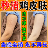 岩井昃弘鸡皮肤疙瘩毛囊角化专用去除大腿胳膊手臂神器药膏脸上儿童身体乳 单盒装【鸡皮肤克星】 去除毛周角化症皮肤干燥磨砂膏尿素霜精华