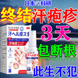 岩井昃弘汗疱疹100%专用膏药湿疹止痒去根手脚上起水泡痒止痒去真菌感染 特效1盒装【一喷舒服】