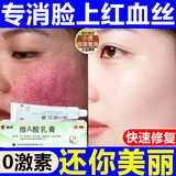 去红血丝修复角质层薄敏感肌修复医用过敏皮肤脸部泛红敏感修复去除修复红血丝增厚角质层维a酸乳膏 1盒【0激素放心用】